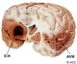 intracerebral hemorrhage