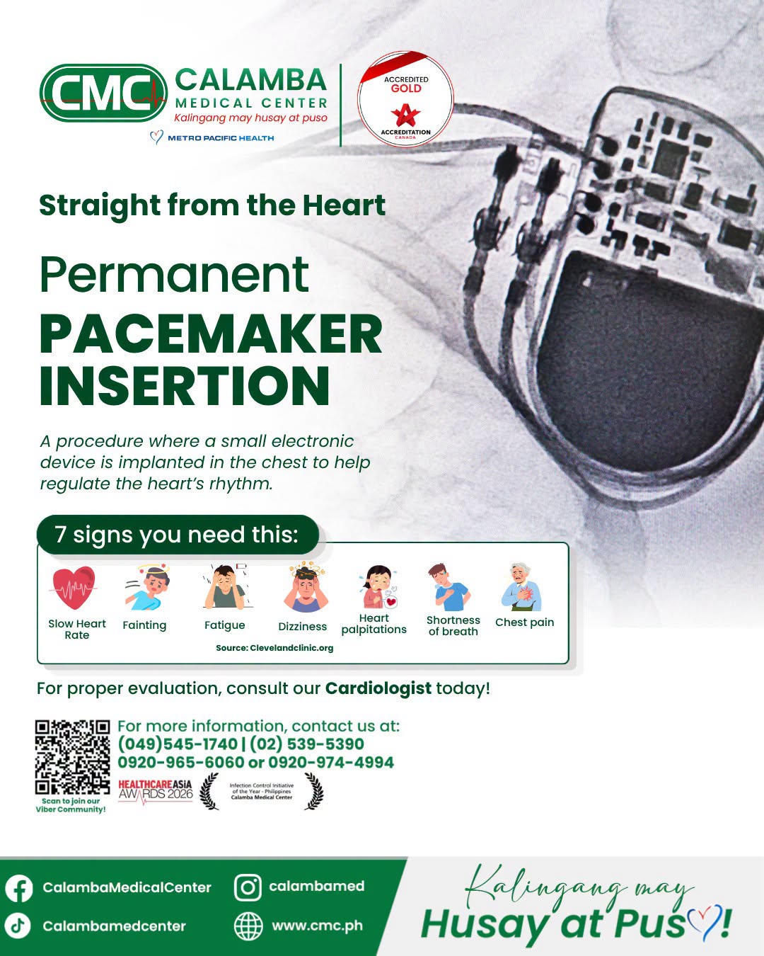 PAcemaker
